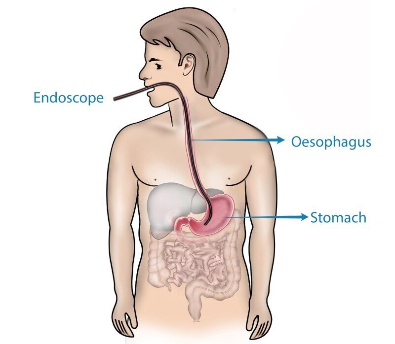 bron endoscopy perth (1)