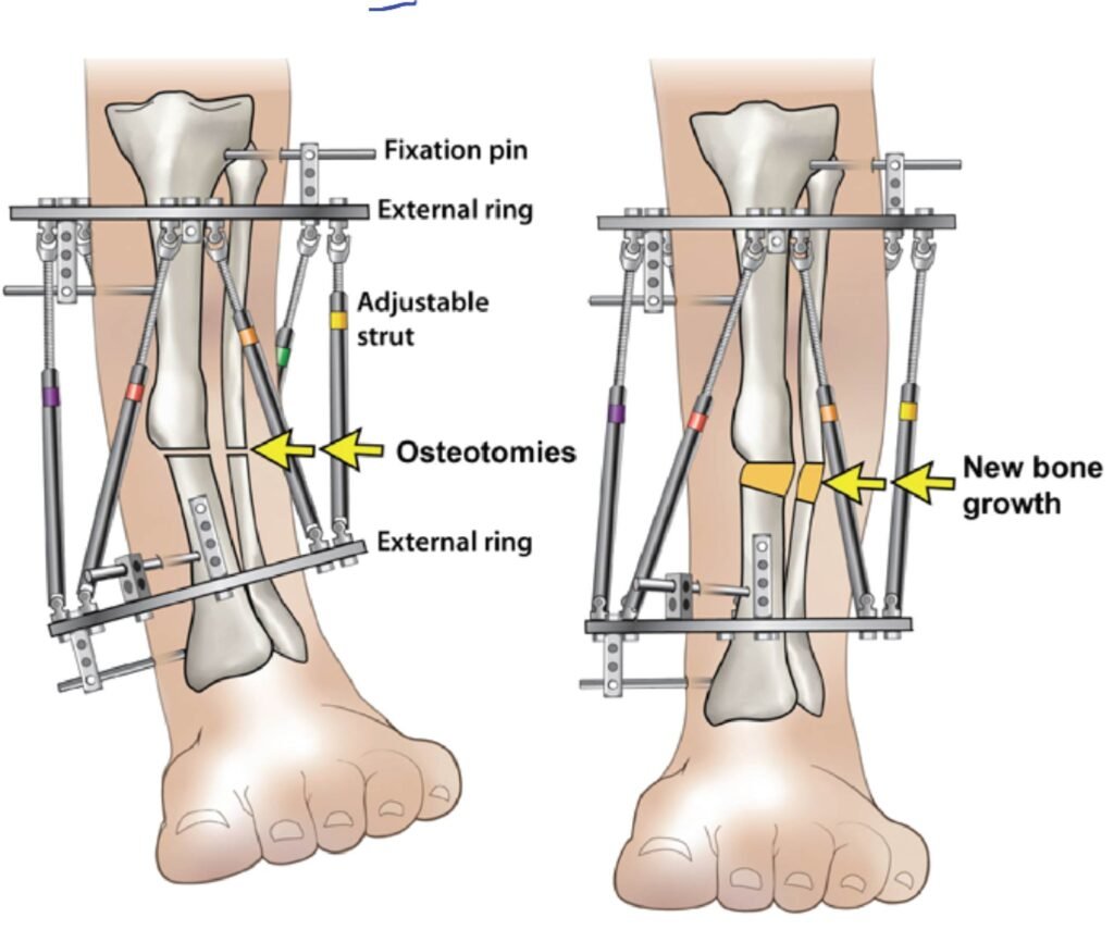 orthopaedic surgeon height limb lengthening and deformity correction program at elaj medical centre ajman 2 01