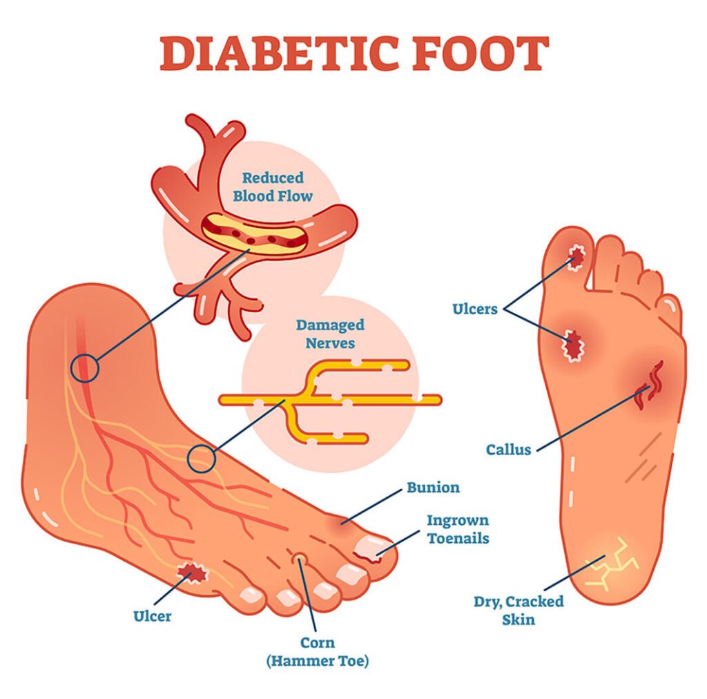 diabetic foot diagram